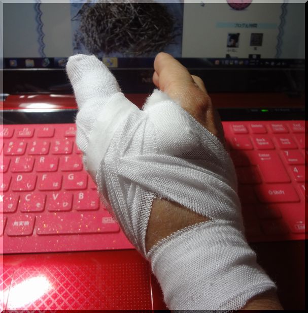 右手親指を怪我すると大変 My Favorite Bloguru 右手親指を怪我すると大変 My Favorite Bloguru