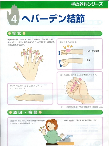 へバーデン結節　(⌒▽⌒；) ...