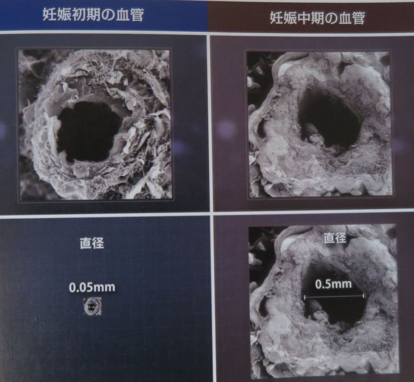 恵みの窓（ラセン動脈）の直径