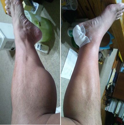 筋肉痛