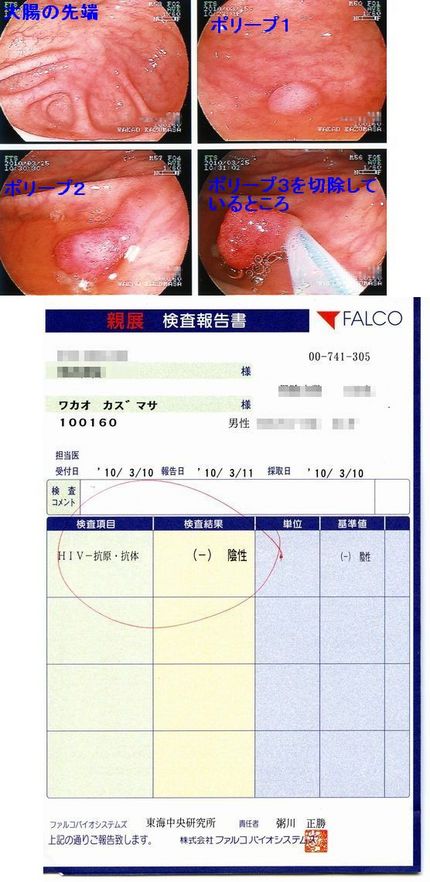 大腸内視鏡検査結果（注：大腸内...