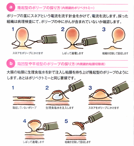 大腸ポリープの病理検査結果