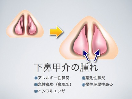 両下鼻甲介粘膜焼灼術から三ヶ月