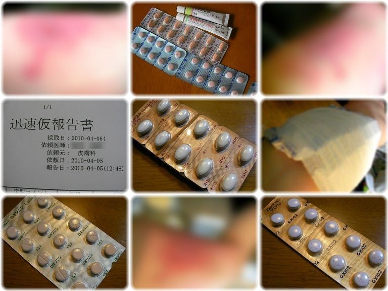 蜂窩織炎 蜂巣炎 丹毒 豆腐日記 毎日豆腐食べてます Bloguru