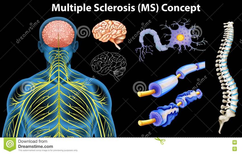 MS prevention at the microbio...