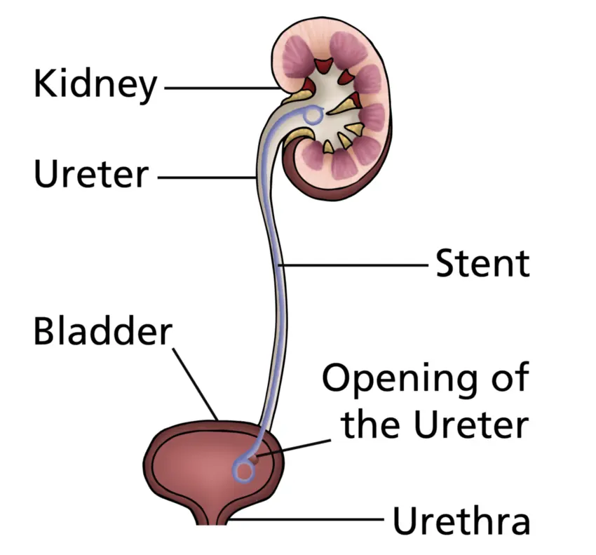 Stent Removal